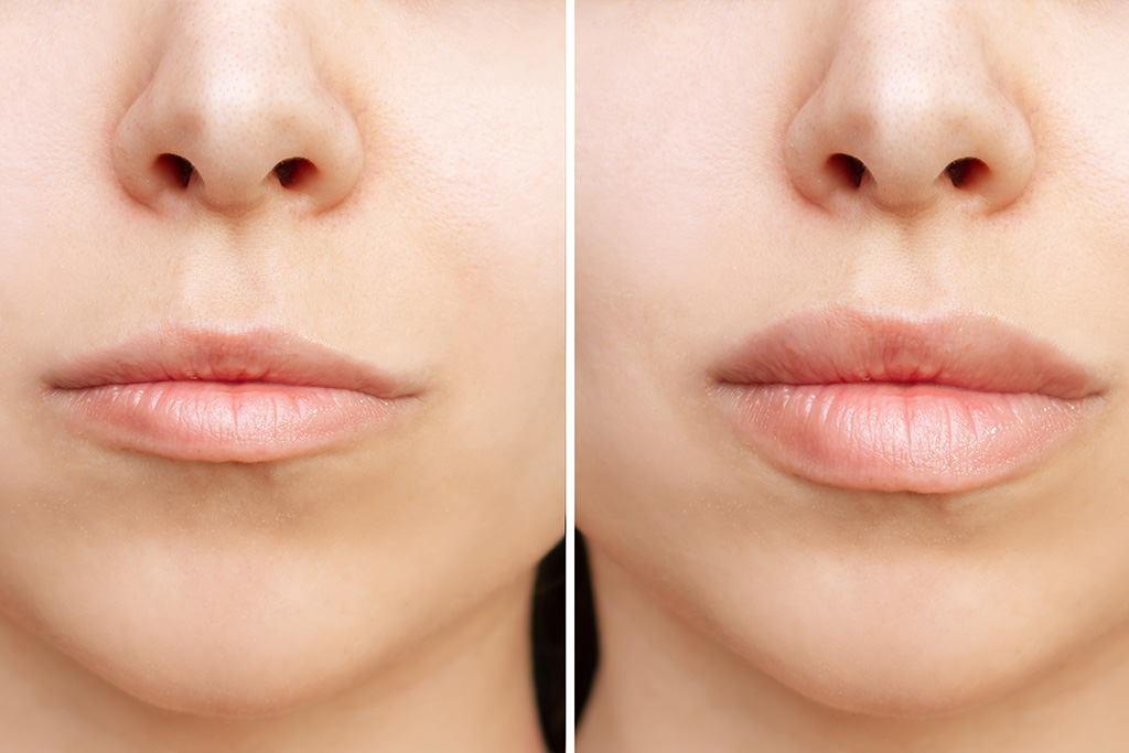 lip lift yaptiranlar