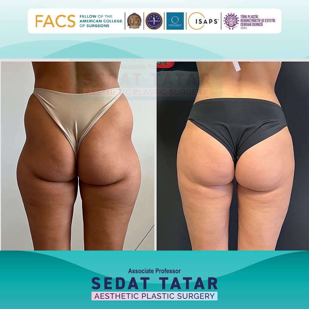 Brazilian Butt Lift(BBL) - Sedat Tatar MD FACS Plastic Surgeon in Turkey