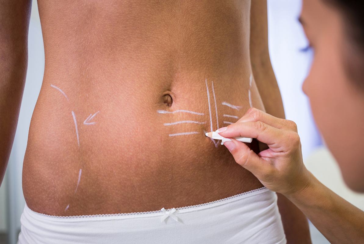 Your Comprehensive Guide to Tummy Tuck Surgery