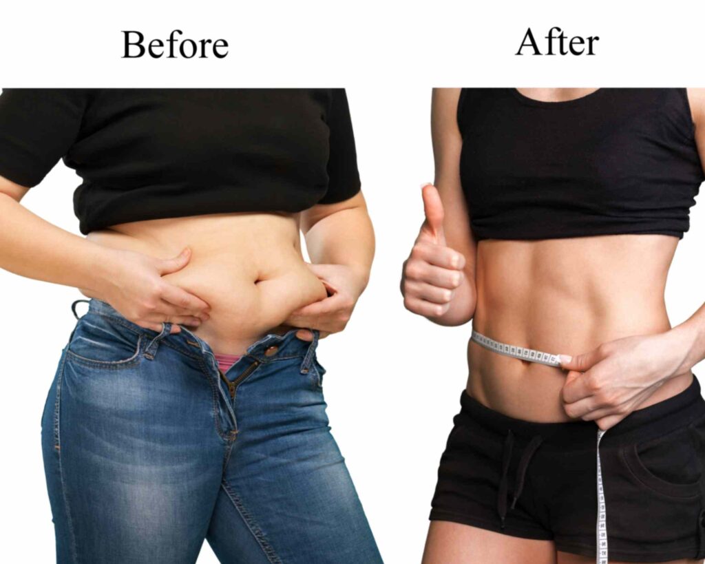 Tummy Tuck in Turkey