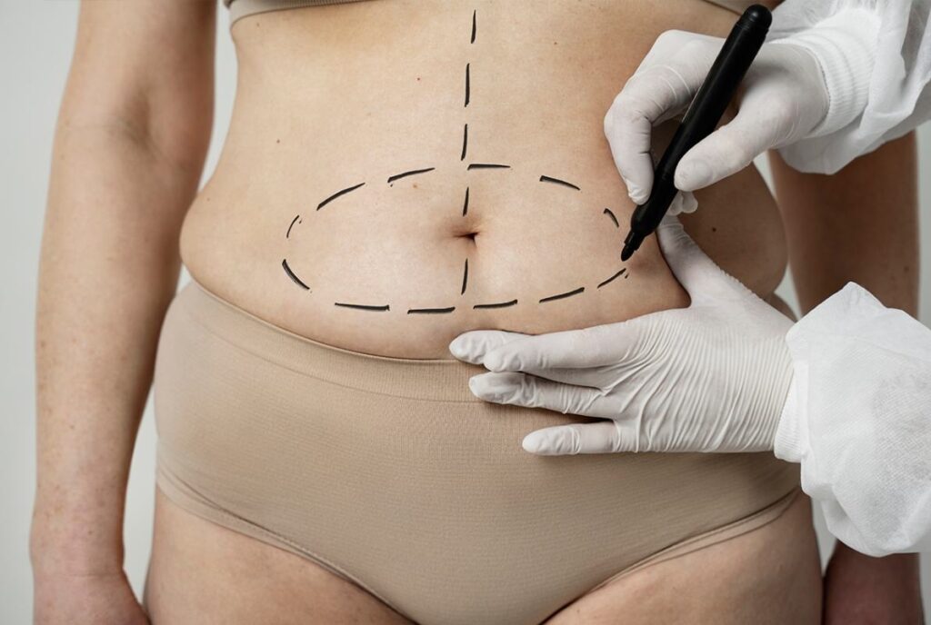 Tummy Tuck in Istanbul