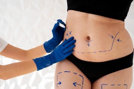 Liposuction Surgery Procedure