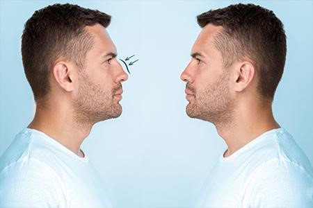 rhinoplasty surgeon in turkey