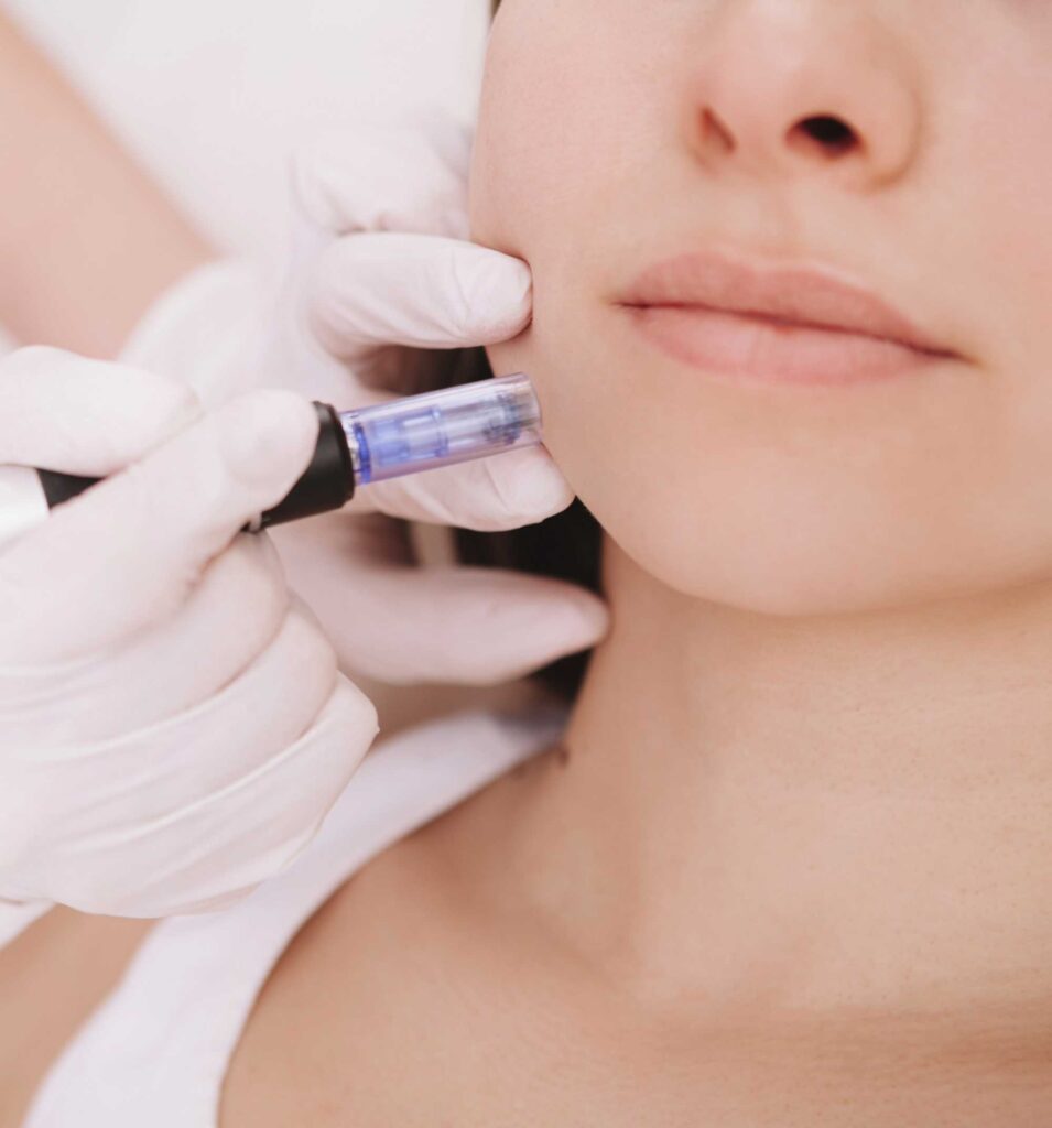 Patient undergoing mesotherapy in Turkey, a treatment that involves micro-injections to enhance skin hydration, elasticity, and overall health.