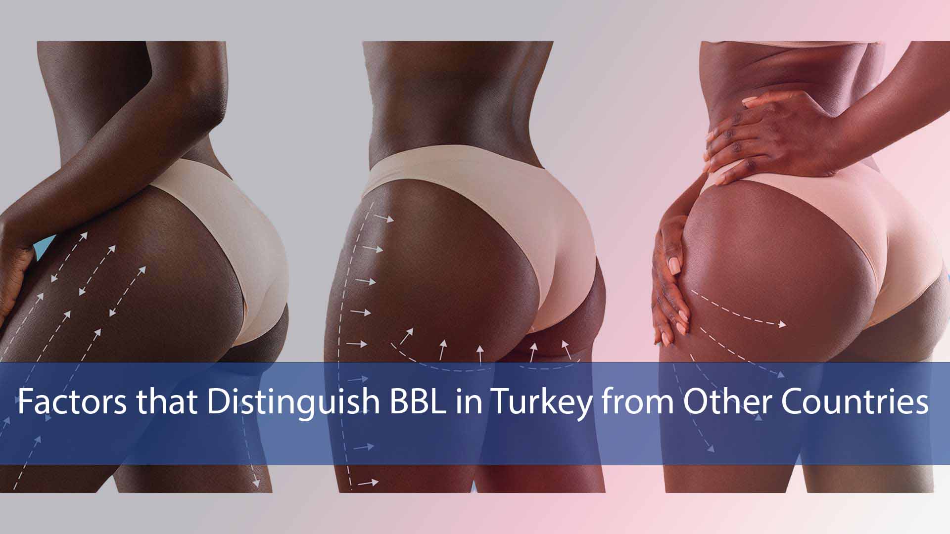 Factors that Distinguish BBL in Turkey from Other Countries