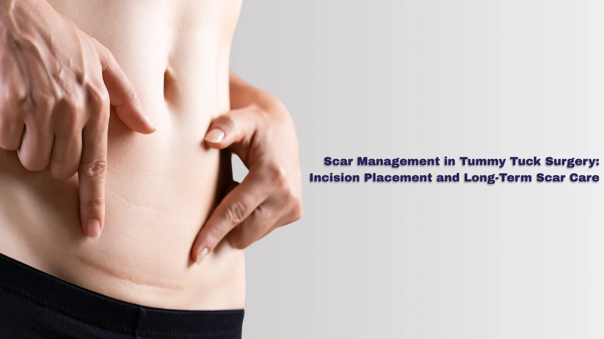 Scar Management Program Scar Management in Tummy Tuck Surgery: Incision Placement and Long-Term ...